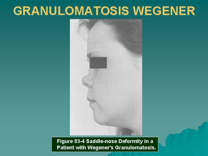 GRANULOMATOSIS WEGENER Figure 83 -4 Saddle-nose Deformity in a Patient with Wegener's Granulomatosis. 