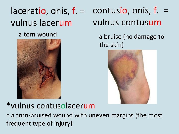 laceratio, onis, f. = contusio, onis, f. = vulnus contusum vulnus lacerum a torn