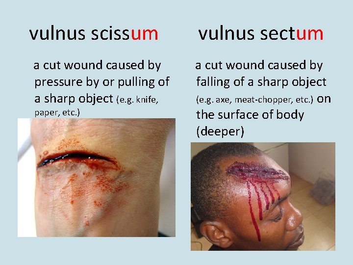 vulnus scissum a cut wound caused by pressure by or pulling of a sharp