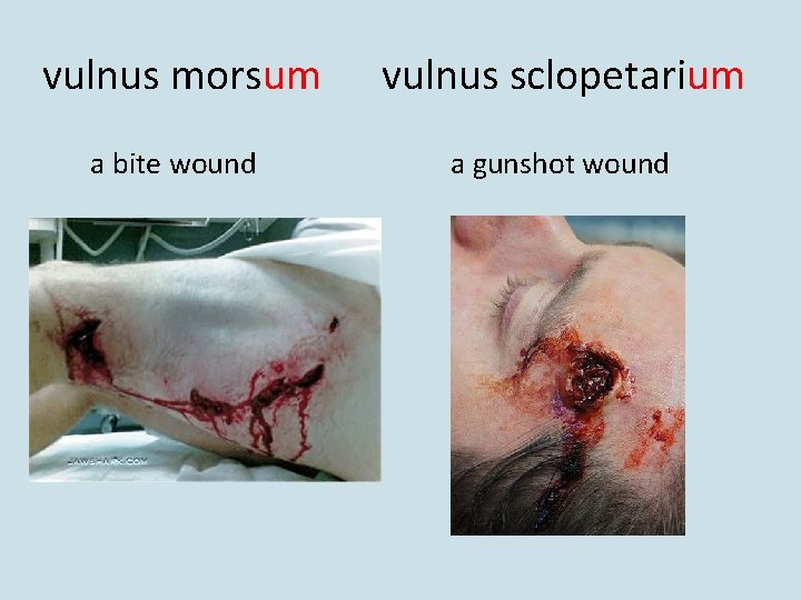 vulnus morsum vulnus sclopetarium a bite wound a gunshot wound 