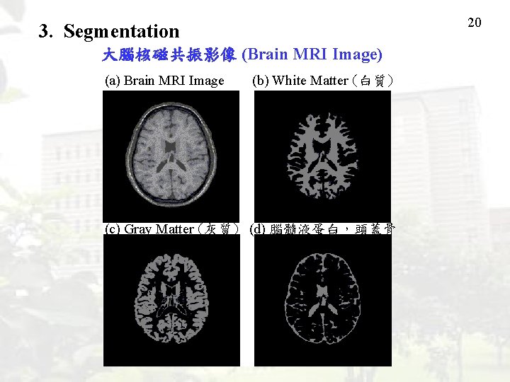 20 3. Segmentation 大腦核磁共振影像 (Brain MRI Image) (a) Brain MRI Image (b) White Matter