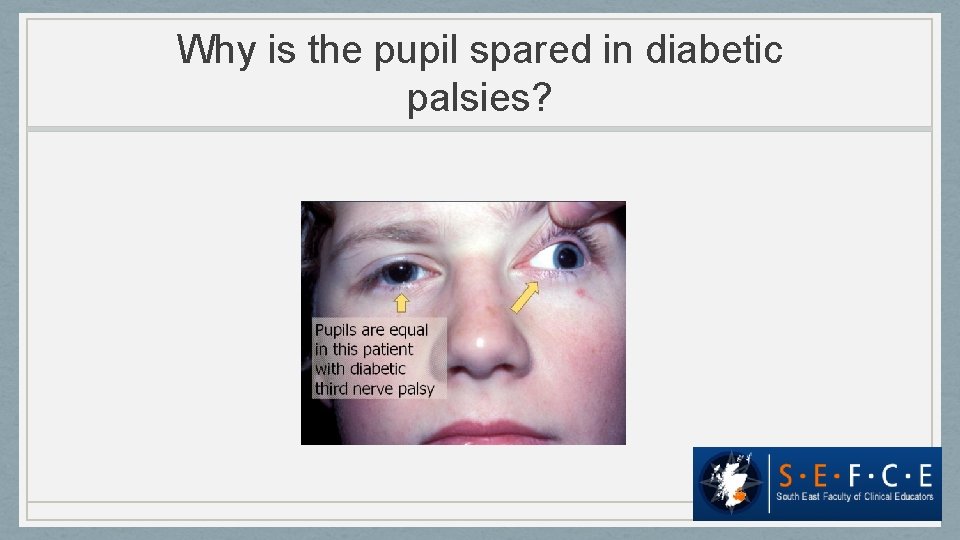 Why is the pupil spared in diabetic palsies? 