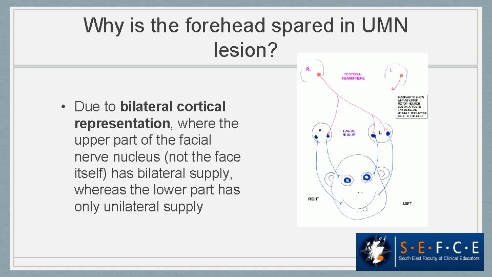 Why is the forehead spared in UMN lesion? • Due to bilateral cortical representation,