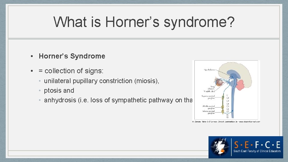 What is Horner’s syndrome? • Horner’s Syndrome • = collection of signs: • unilateral