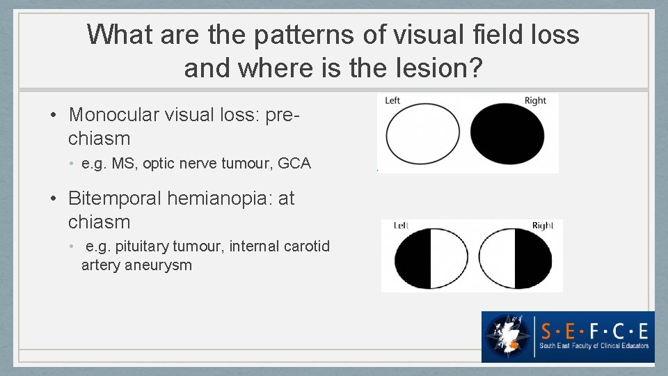 What are the patterns of visual field loss and where is the lesion? •