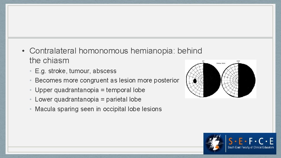  • Contralateral homonomous hemianopia: behind the chiasm • • • E. g. stroke,