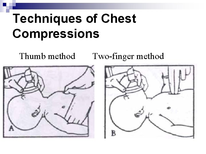 Techniques of Chest Compressions Thumb method Two-finger method 
