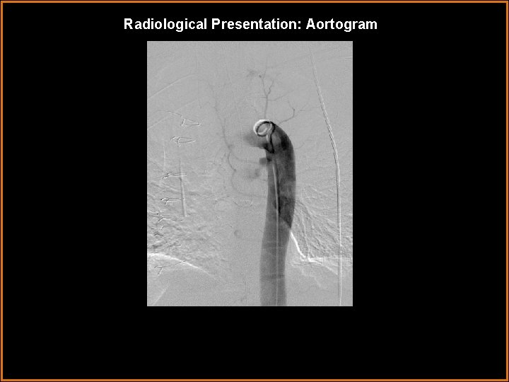 Radiological Presentation: Aortogram 