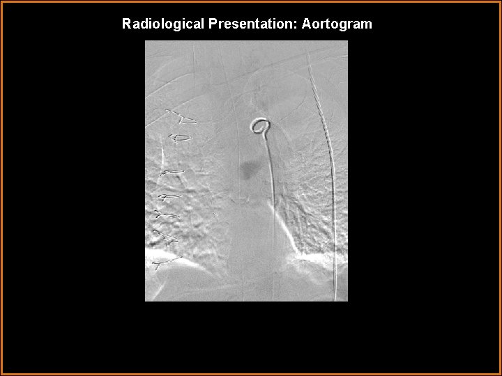 Radiological Presentation: Aortogram 