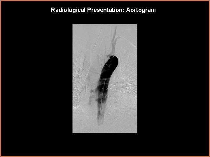 Radiological Presentation: Aortogram 