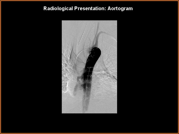 Radiological Presentation: Aortogram 