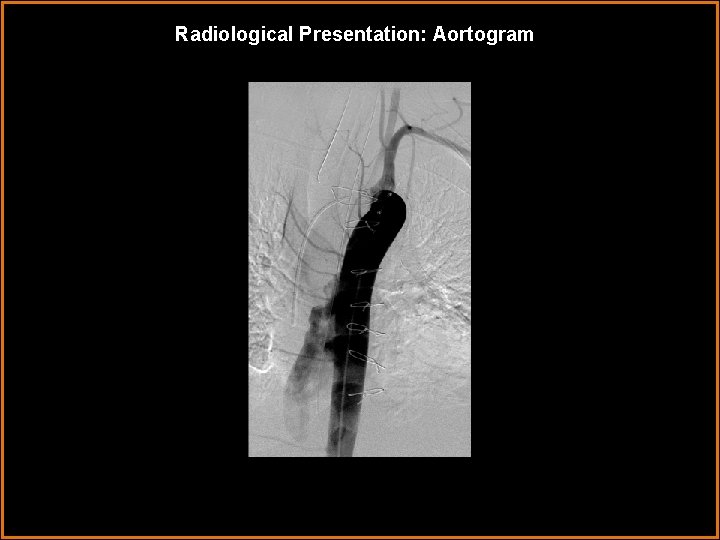 Radiological Presentation: Aortogram 