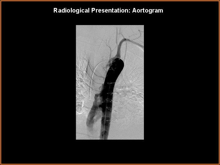Radiological Presentation: Aortogram 