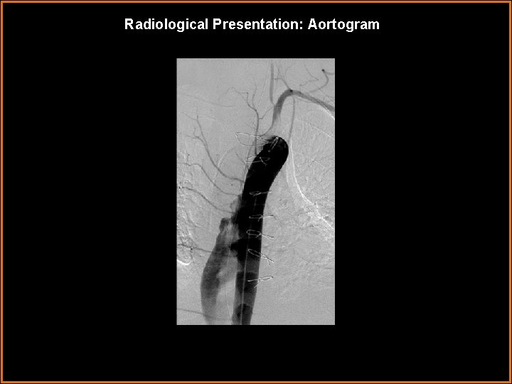 Radiological Presentation: Aortogram 