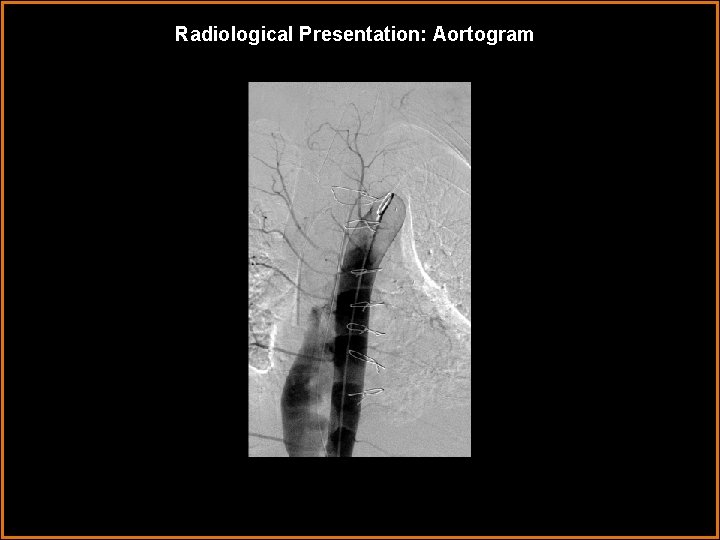 Radiological Presentation: Aortogram 