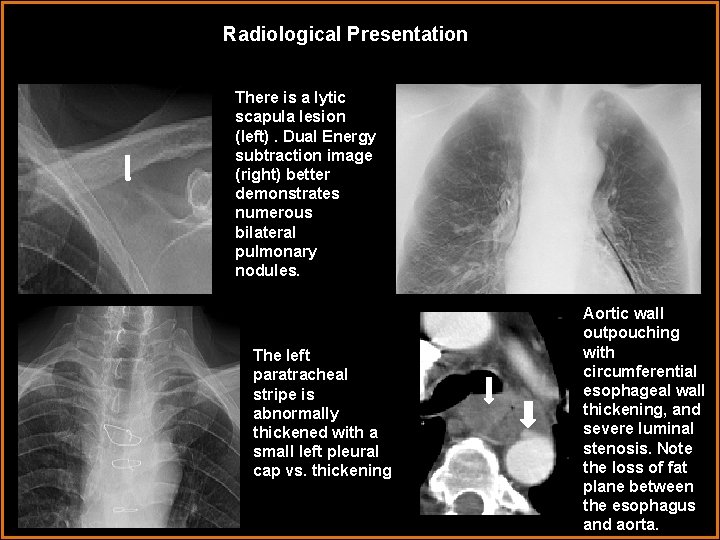 Radiological Presentation There is a lytic scapula lesion (left). Dual Energy subtraction image (right)