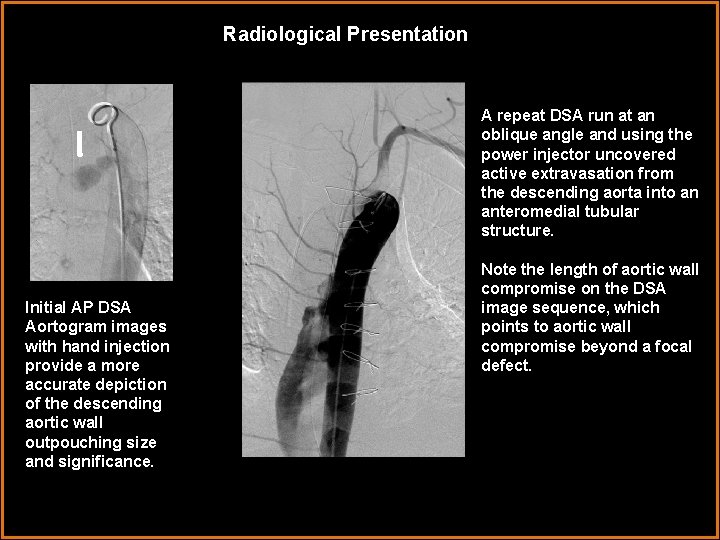 Radiological Presentation A repeat DSA run at an oblique angle and using the power