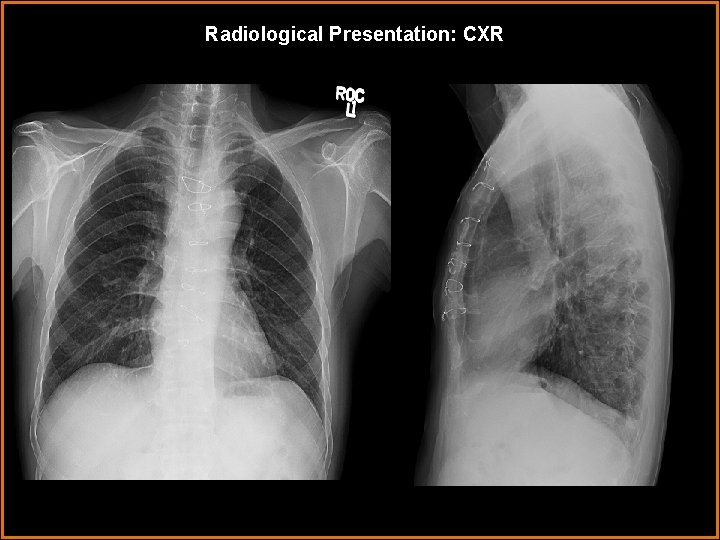 Radiological Presentation: CXR 