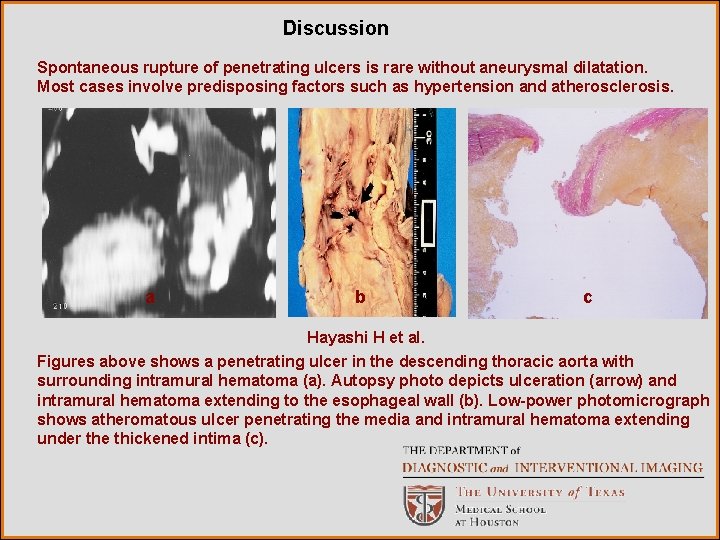 Discussion Spontaneous rupture of penetrating ulcers is rare without aneurysmal dilatation. Most cases involve
