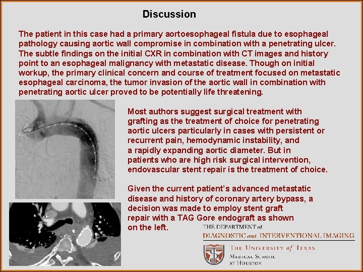 Discussion The patient in this case had a primary aortoesophageal fistula due to esophageal