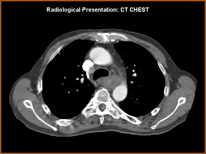 Radiological Presentation: CT CHEST 