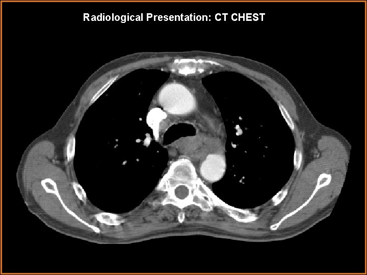 Radiological Presentation: CT CHEST 