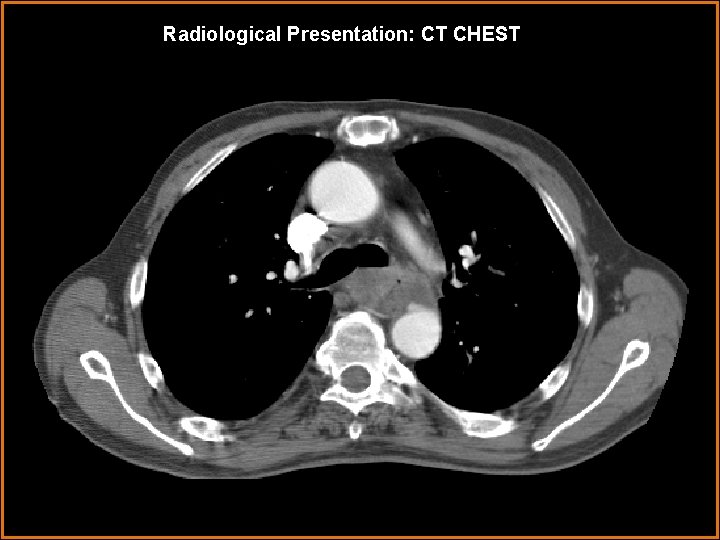 Radiological Presentation: CT CHEST 