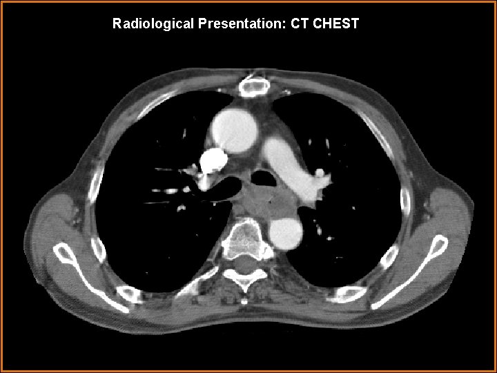 Radiological Presentation: CT CHEST 