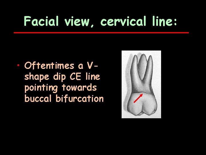 Facial view, cervical line: • Oftentimes a Vshape dip CE line pointing towards buccal
