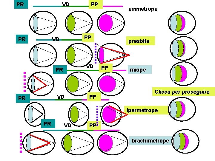 PR VD PR emmetrope PP VD VD PR PP PP presbite PP miope Clicca