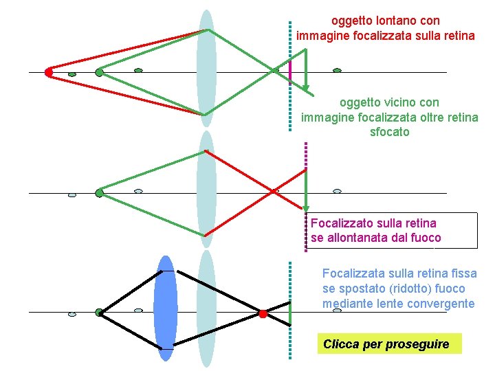 oggetto lontano con immagine focalizzata sulla retina oggetto vicino con immagine focalizzata oltre retina