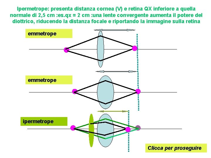 Ipermetrope: presenta distanza cornea (V) e retina QX inferiore a quella normale di 2,