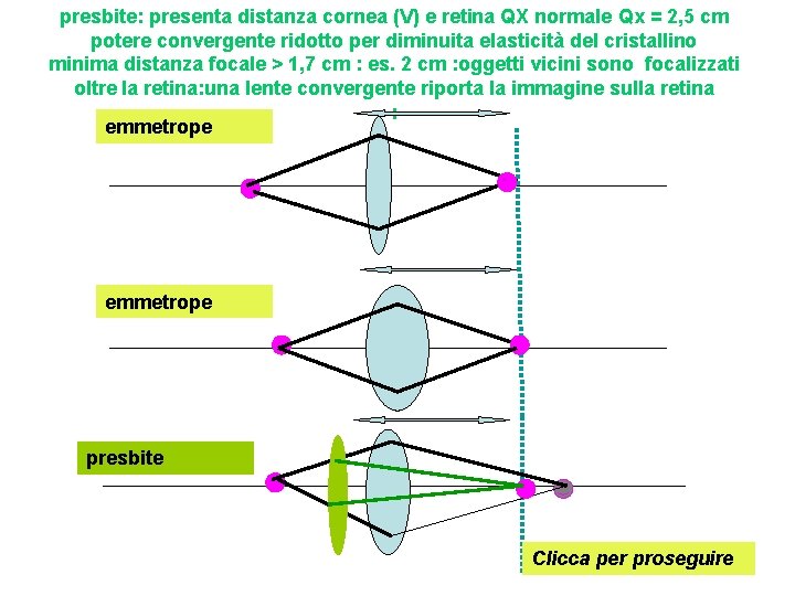 presbite: presenta distanza cornea (V) e retina QX normale Qx = 2, 5 cm