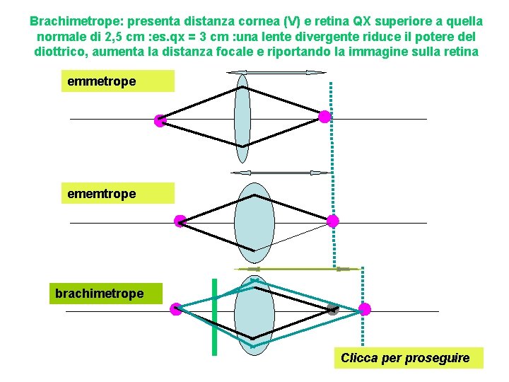 Brachimetrope: presenta distanza cornea (V) e retina QX superiore a quella normale di 2,