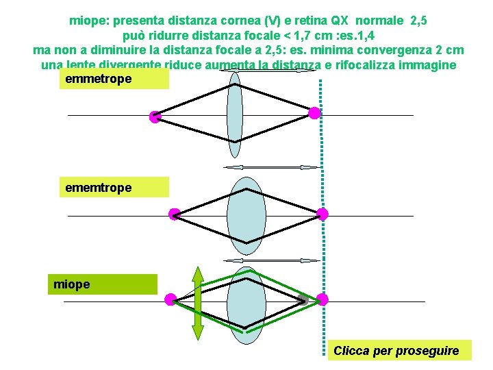 miope: presenta distanza cornea (V) e retina QX normale 2, 5 può ridurre distanza