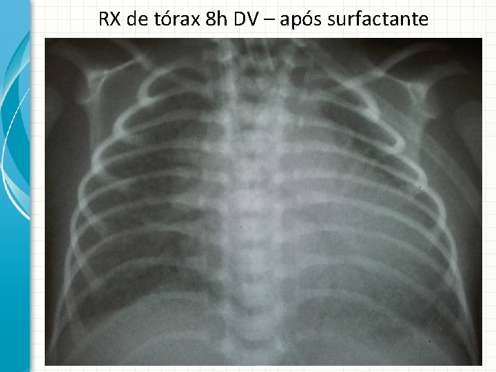RX de tórax 8 h DV – após surfactante 