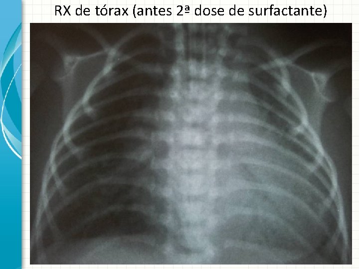 RX de tórax (antes 2ª dose de surfactante) 