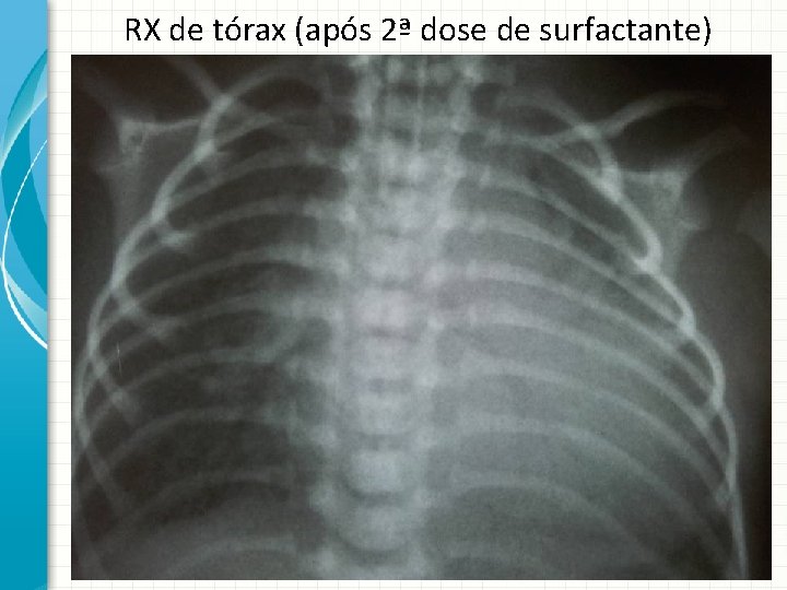 RX de tórax (após 2ª dose de surfactante) 