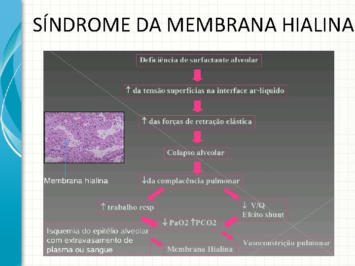 SÍNDROME DA MEMBRANA HIALINA 