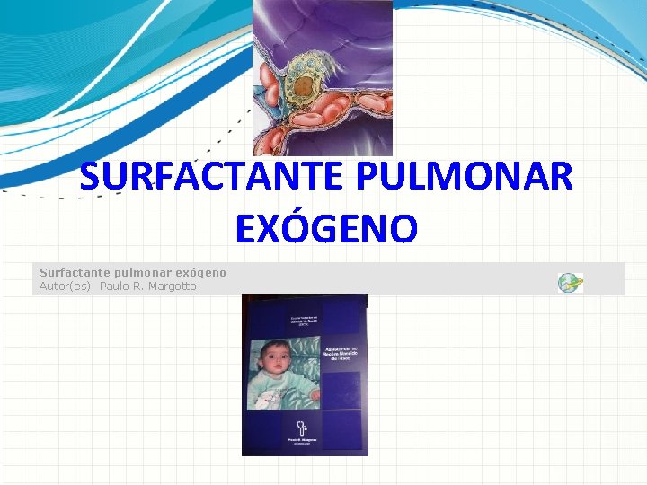 SURFACTANTE PULMONAR EXÓGENO Surfactante pulmonar exógeno Autor(es): Paulo R. Margotto 