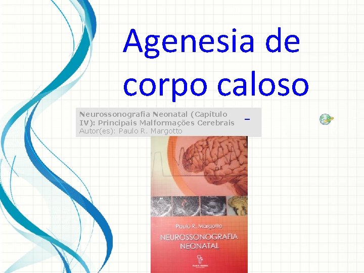 Agenesia de corpo caloso Neurossonografia Neonatal (Capítulo IV): Principais Malformações Cerebrais Autor(es): Paulo R.
