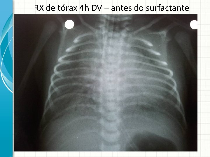 RX de tórax 4 h DV – antes do surfactante 