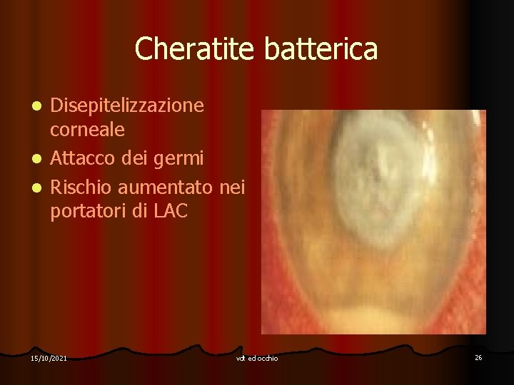 Cheratite batterica l l l Disepitelizzazione corneale Attacco dei germi Rischio aumentato nei portatori