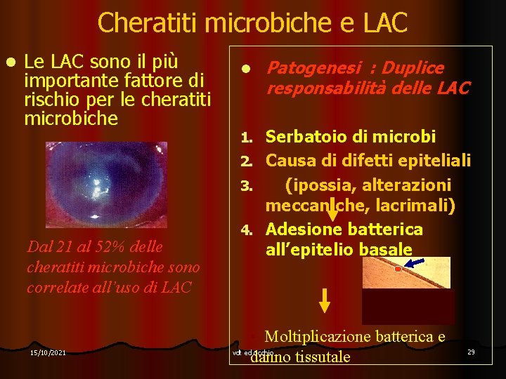 Cheratiti microbiche e LAC l Le LAC sono il più importante fattore di rischio