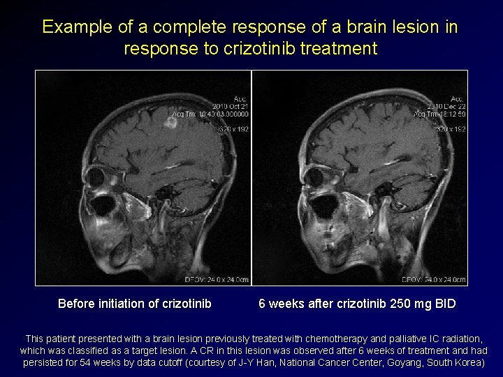 Example of a complete response of a brain lesion in response to crizotinib treatment