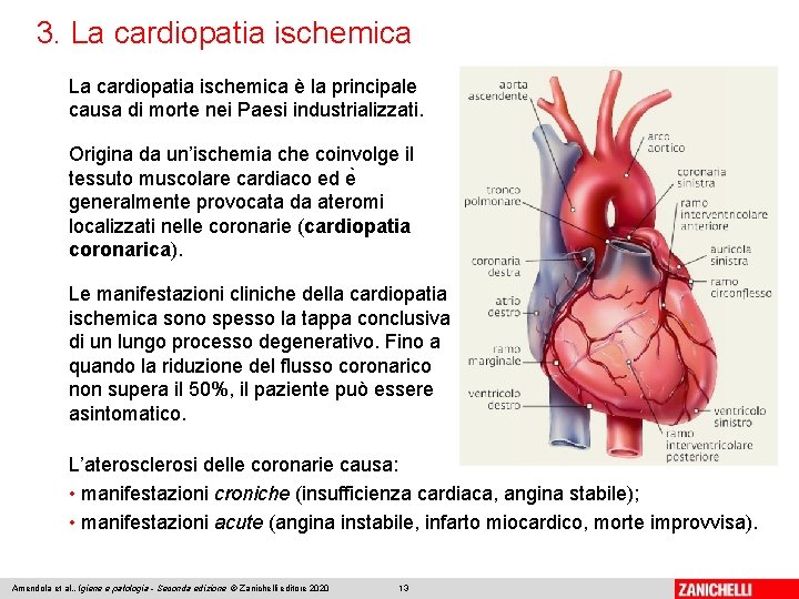 3. La cardiopatia ischemica è la principale causa di morte nei Paesi industrializzati. Origina