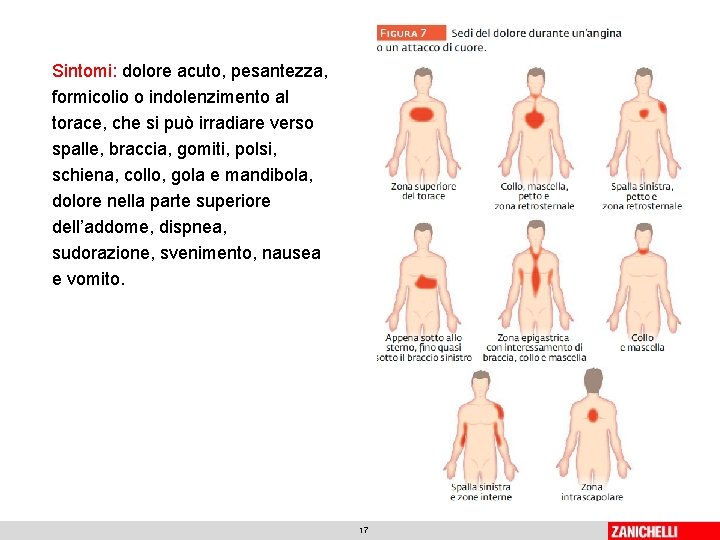 Sintomi: dolore acuto, pesantezza, formicolio o indolenzimento al torace, che si può irradiare verso