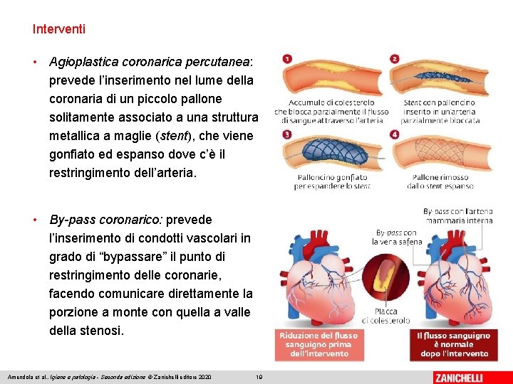 Interventi • Agioplastica coronarica percutanea: prevede l’inserimento nel lume della coronaria di un piccolo