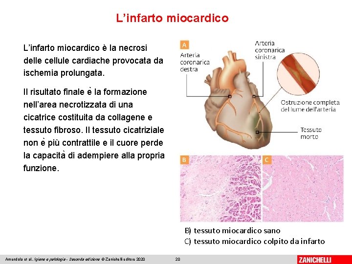 L’infarto miocardico è la necrosi delle cellule cardiache provocata da ischemia prolungata. Il risultato
