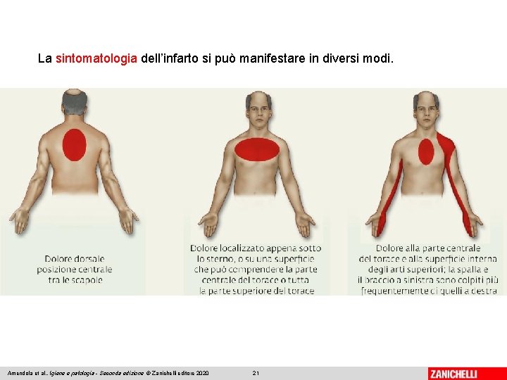 La sintomatologia dell’infarto si può manifestare in diversi modi. Amendola et al. , Igiene